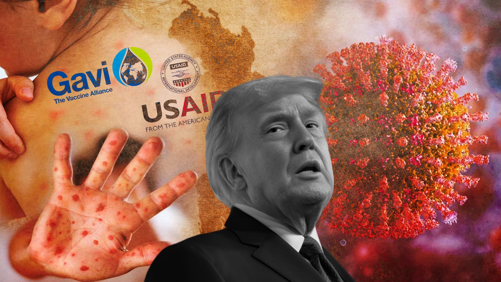 বাংলাদেশে হামের প্রাদুর্ভাব ও বৈশ্বিক স্বাস্থ্য সংকট: ট্রাম্প কি দায় এড়াতে পারেন?