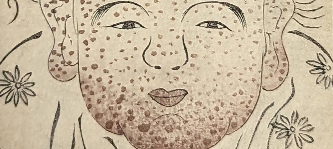 হাম আবিষ্কারের গল্প ও তার বারবার ফিরে আসা