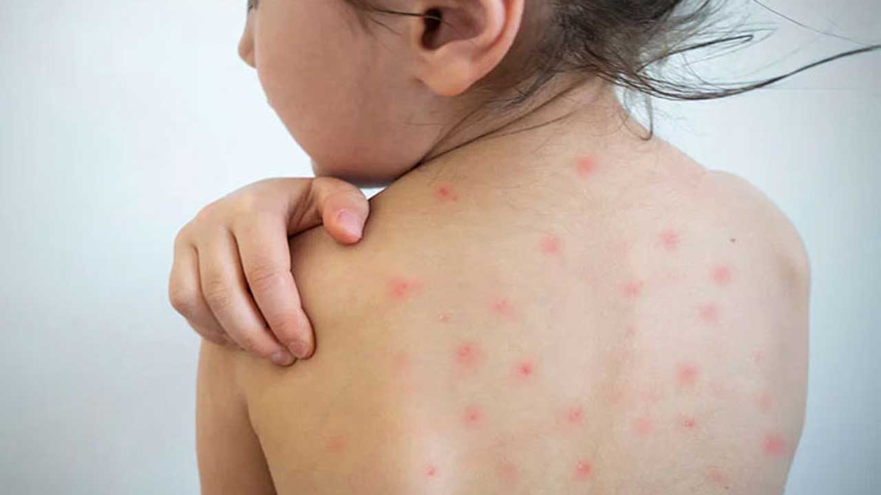 হামের প্রাদুর্ভাব: সচেতনতা ও ধৈর্যই ইসলামের শিক্ষা